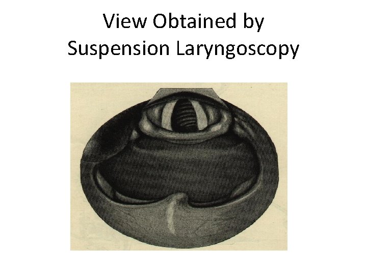 View Obtained by Suspension Laryngoscopy 