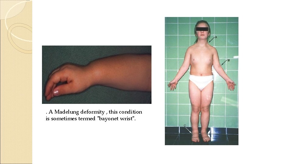 . A Madelung deformity , this condition is sometimes termed "bayonet wrist". 
