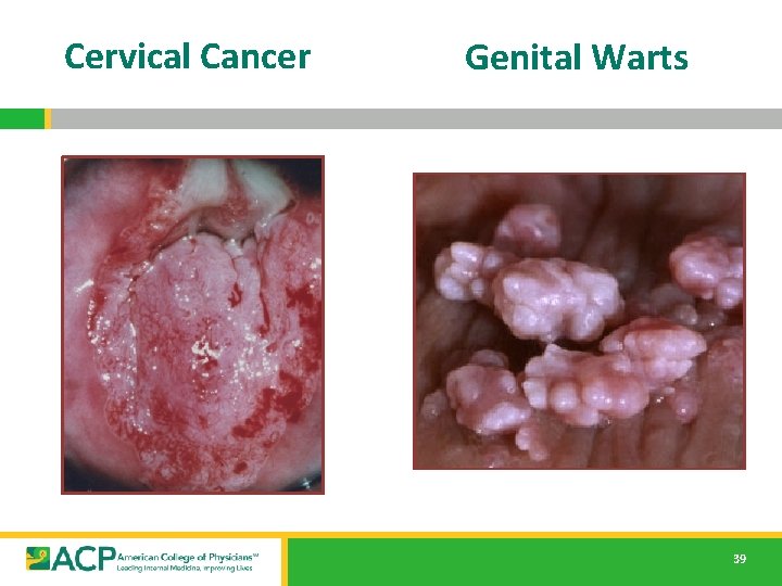 Cervical Cancer Genital Warts 39 
