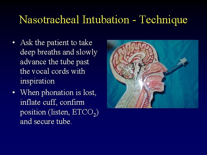 Nasotracheal Intubation - Technique • Ask the patient to take deep breaths and slowly