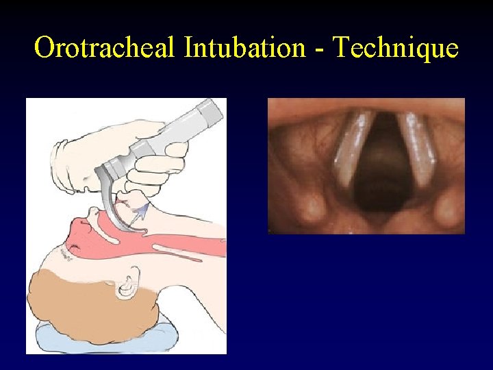 Orotracheal Intubation - Technique 