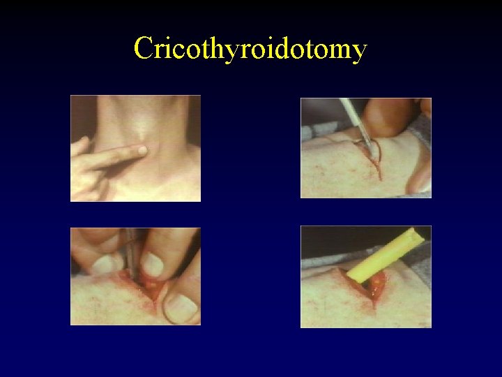 Cricothyroidotomy 