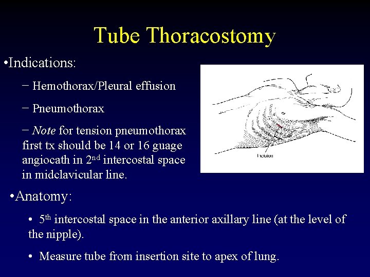 Tube Thoracostomy • Indications: − Hemothorax/Pleural effusion − Pneumothorax − Note for tension pneumothorax