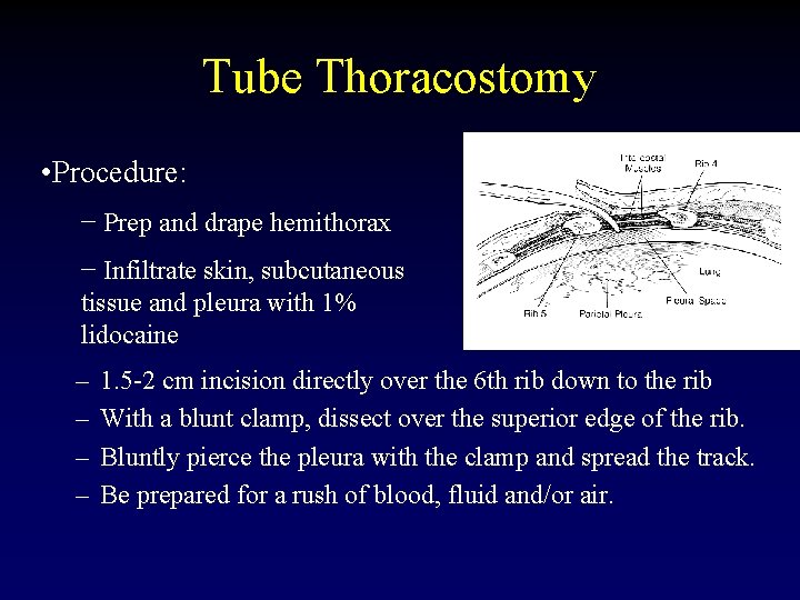 Tube Thoracostomy • Procedure: − Prep and drape hemithorax − Infiltrate skin, subcutaneous tissue