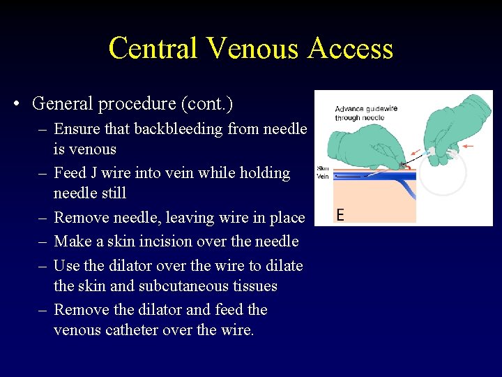 Central Venous Access • General procedure (cont. ) – Ensure that backbleeding from needle