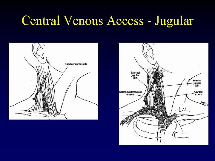 Central Venous Access - Jugular 