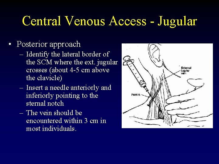 Central Venous Access - Jugular • Posterior approach – Identify the lateral border of