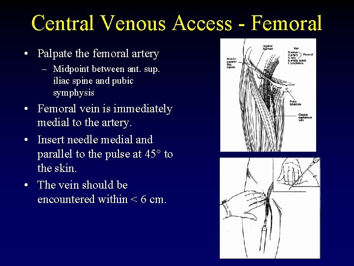 Central Venous Access - Femoral • Palpate the femoral artery – Midpoint between ant.