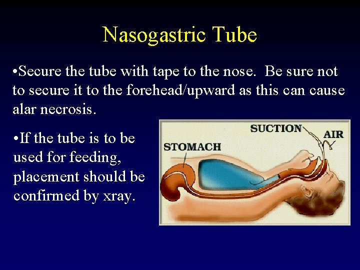 Nasogastric Tube • Secure the tube with tape to the nose. Be sure not