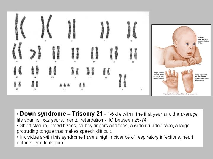  • Down syndrome – Trisomy 21 - 1/6 die within the first year
