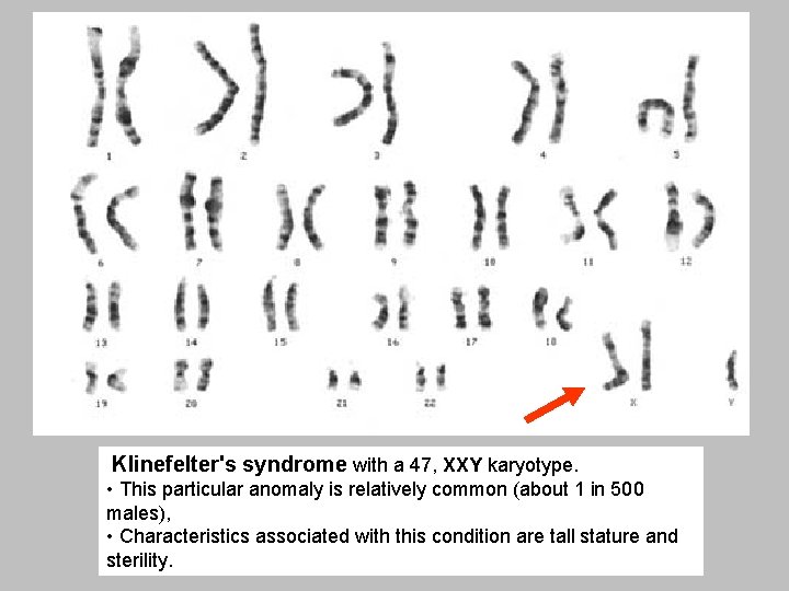 Klinefelter's syndrome with a 47, XXY karyotype. • This particular anomaly is relatively common