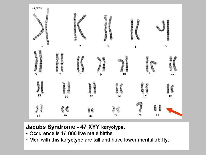 Jacobs Syndrome - 47 XYY karyotype. • Occurence is 1/1000 live male births. •