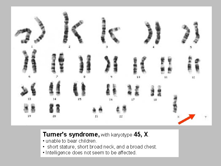 Turner's syndrome, with karyotype 45, X. • unable to bear children. • short stature,