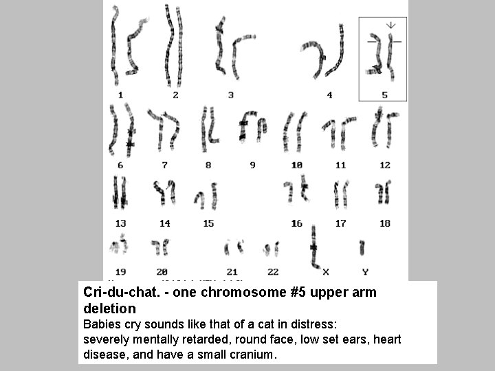 Cri-du-chat. - one chromosome #5 upper arm deletion Babies cry sounds like that of