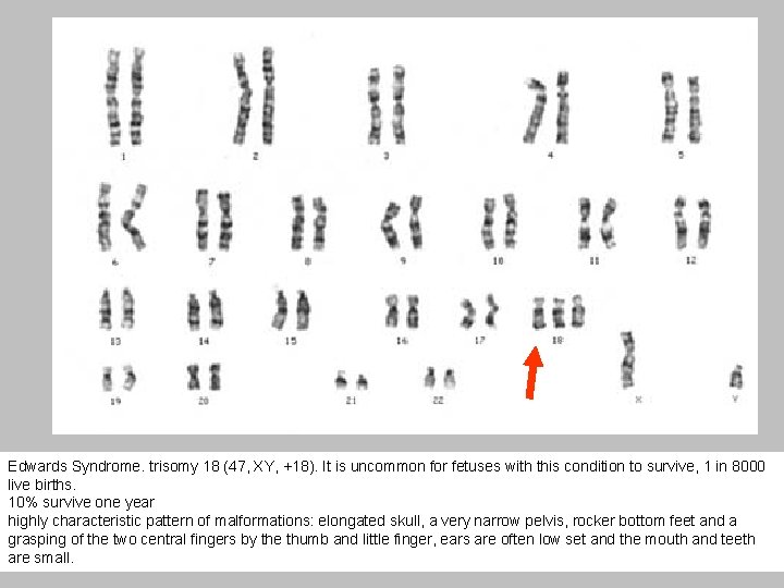 Edwards Syndrome. trisomy 18 (47, XY, +18). It is uncommon for fetuses with this