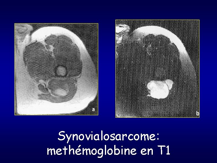 Synovialosarcome: methémoglobine en T 1 