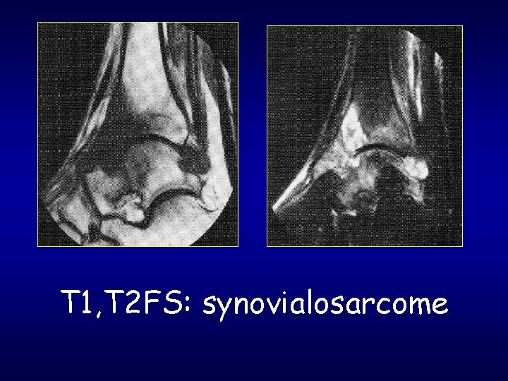 T 1, T 2 FS: synovialosarcome 