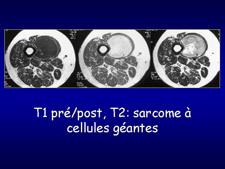 T 1 pré/post, T 2: sarcome à cellules géantes 