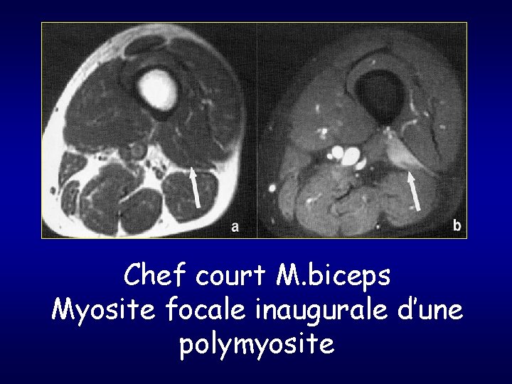 Chef court M. biceps Myosite focale inaugurale d’une polymyosite 