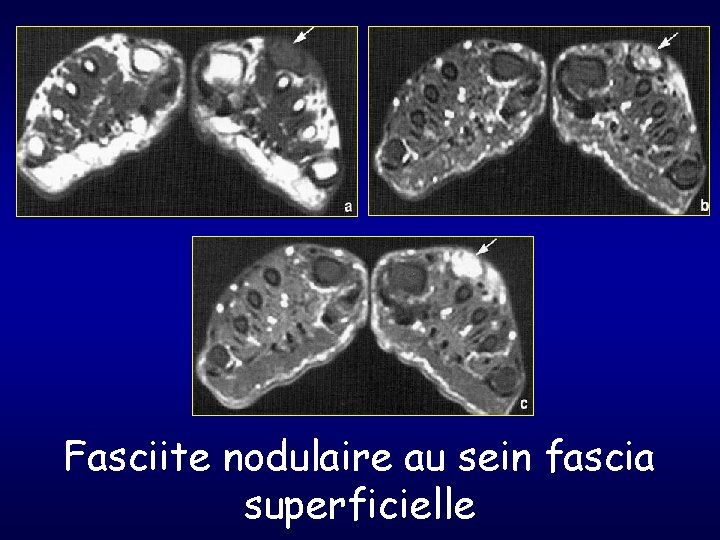 Fasciite nodulaire au sein fascia superficielle 