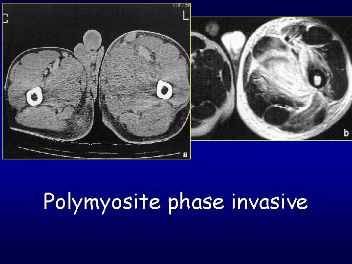 Polymyosite phase invasive 