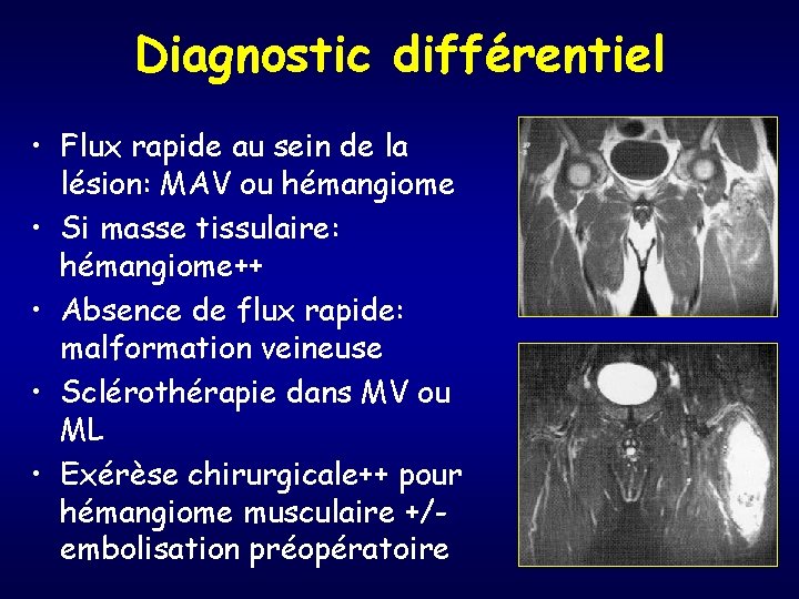 Diagnostic différentiel • Flux rapide au sein de la lésion: MAV ou hémangiome •