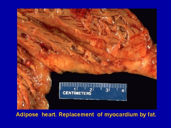 Adipose heart. Replacement of myocardium by fat. 