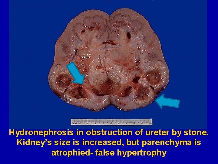 Hydronephrosis in obstruction of ureter by stone. Kidney’s size is increased, but parenchyma is