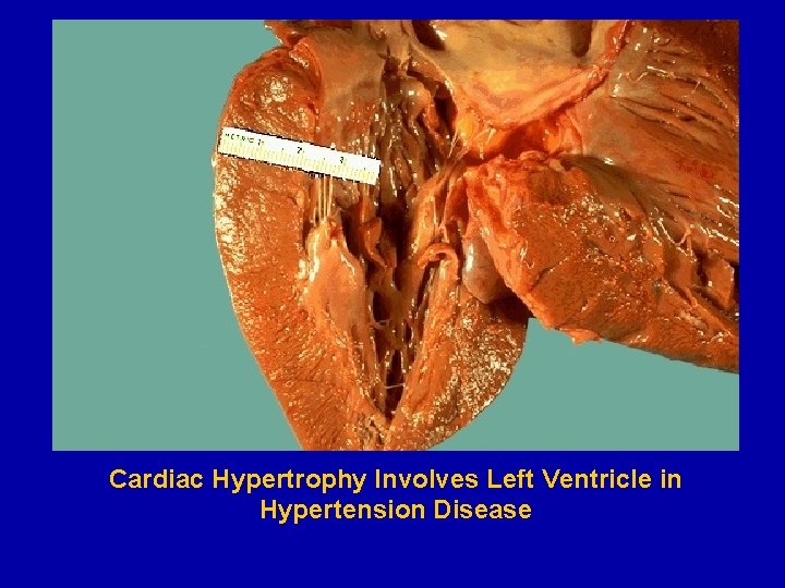 Cardiac Hypertrophy Involves Left Ventricle in Hypertension Disease 