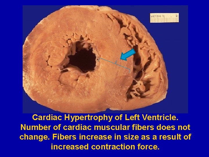 Cardiac Hypertrophy of Left Ventricle. Number of cardiac muscular fibers does not change. Fibers