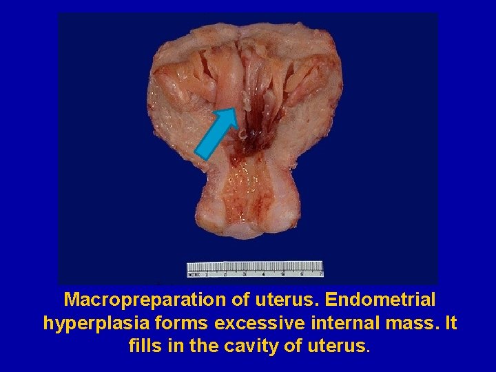 Macropreparation of uterus. Endometrial hyperplasia forms excessive internal mass. It fills in the cavity