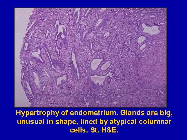 Hypertrophy of endometrium. Glands are big, unusual in shape, lined by atypical columnar cells.