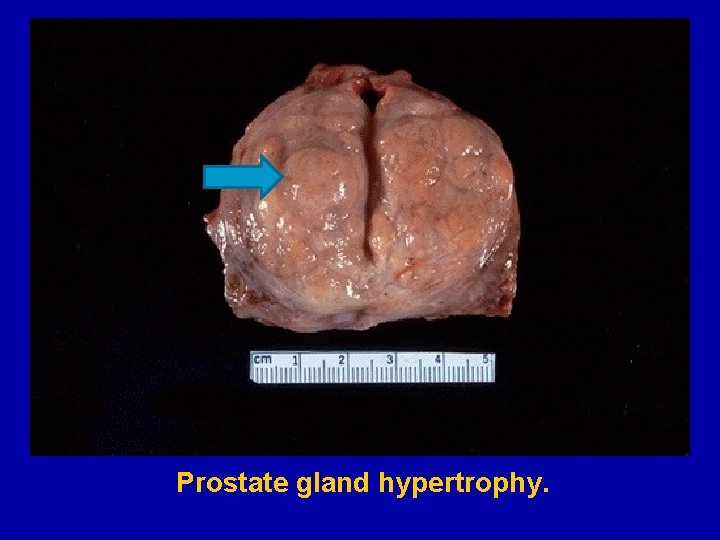 Prostate gland hypertrophy. 