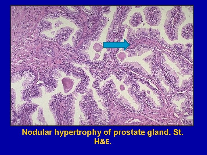 Nodular hypertrophy of prostate gland. St. H&E. 