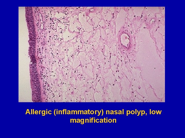 Allergic (inflammatory) nasal polyp, low magnification 