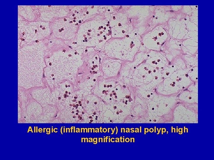 Allergic (inflammatory) nasal polyp, high magnification 