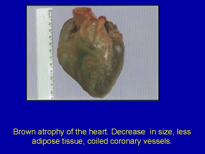 Brown atrophy of the heart. Decrease in size, less adipose tissue, coiled coronary vessels.