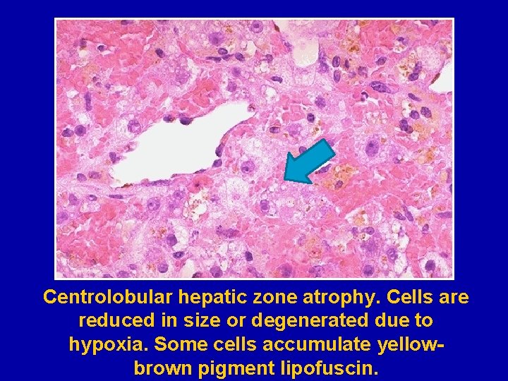 Centrolobular hepatic zone atrophy. Cells are reduced in size or degenerated due to hypoxia.