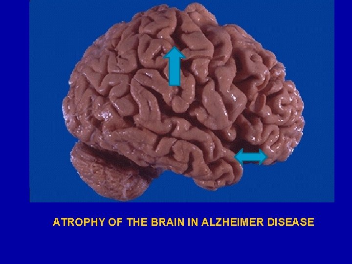 ATROPHY OF THE BRAIN IN ALZHEIMER DISEASE 