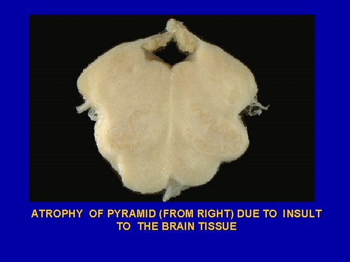 ATROPHY OF PYRAMID (FROM RIGHT) DUE TO INSULT TO THE BRAIN TISSUE 