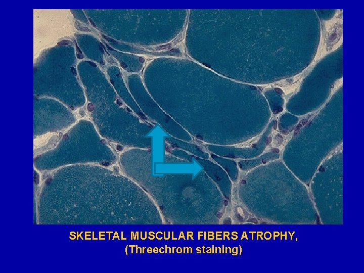 SKELETAL MUSCULAR FIBERS ATROPHY, (Threechrom staining) 