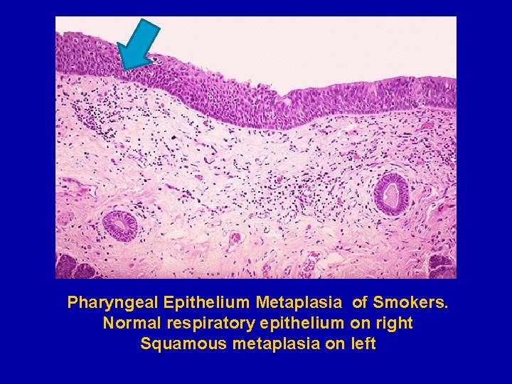 Pharyngeal Epithelium Metaplasia of Smokers. Normal respiratory epithelium on right Squamous metaplasia on left