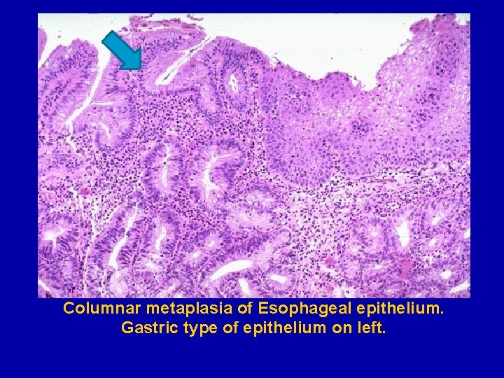 Columnar metaplasia of Esophageal epithelium. Gastric type of epithelium on left. 