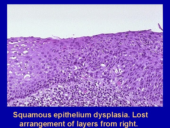 Squamous epithelium dysplasia. Lost arrangement of layers from right. 