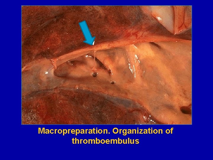 Macropreparation. Organization of thromboembulus 