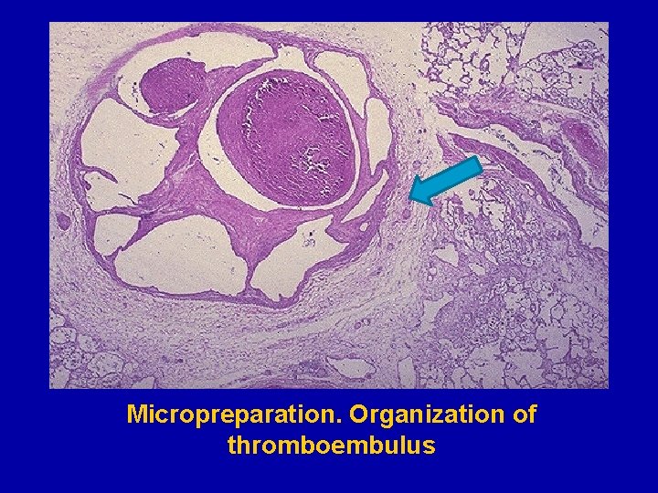 Micropreparation. Organization of thromboembulus 