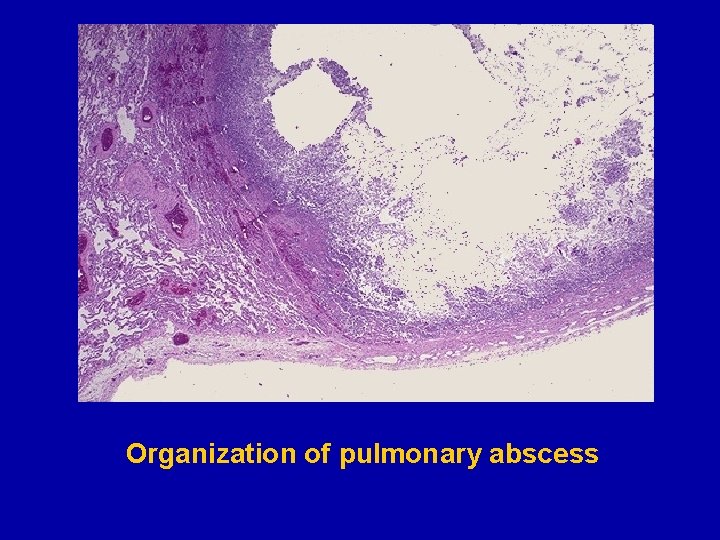 Organization of pulmonary abscess 