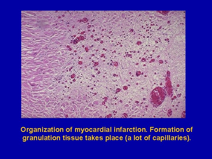 Organization of myocardial infarction. Formation of granulation tissue takes place (a lot of capillaries).