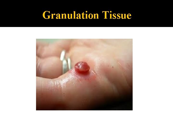 Granulation Tissue 