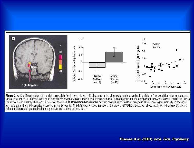 Thomas et al. (2001) Arch. Gen, Psychiatry 